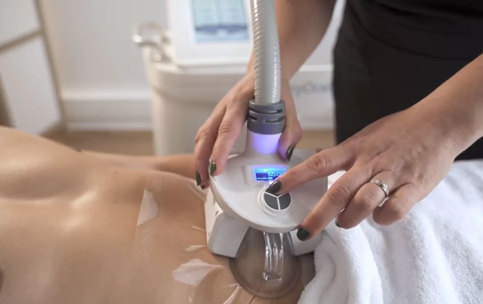 Cryolipolyse amincissement regenair Lille